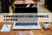 手腕腱鞘炎最佳治疗方法图片,手腕腱鞘炎怎么治疗最有效
