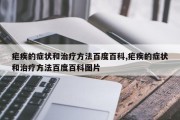 疟疾的症状和治疗方法百度百科,疟疾的症状和治疗方法百度百科图片