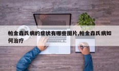 帕金森氏病的症状有哪些图片,帕金森氏病如何治疗